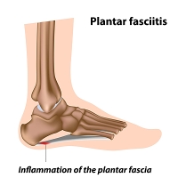 Signs Your Heel Pain Might Be Plantar Fasciitis