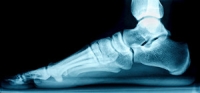 A Common Cause of Adult Acquired Flatfoot