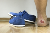 ​​What Are Blood Blisters on the Feet?