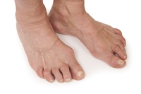 Symptoms of Rheumatoid Arthritis in Feet